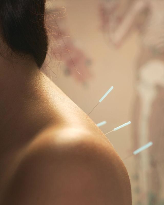 A woman getting acupuncture