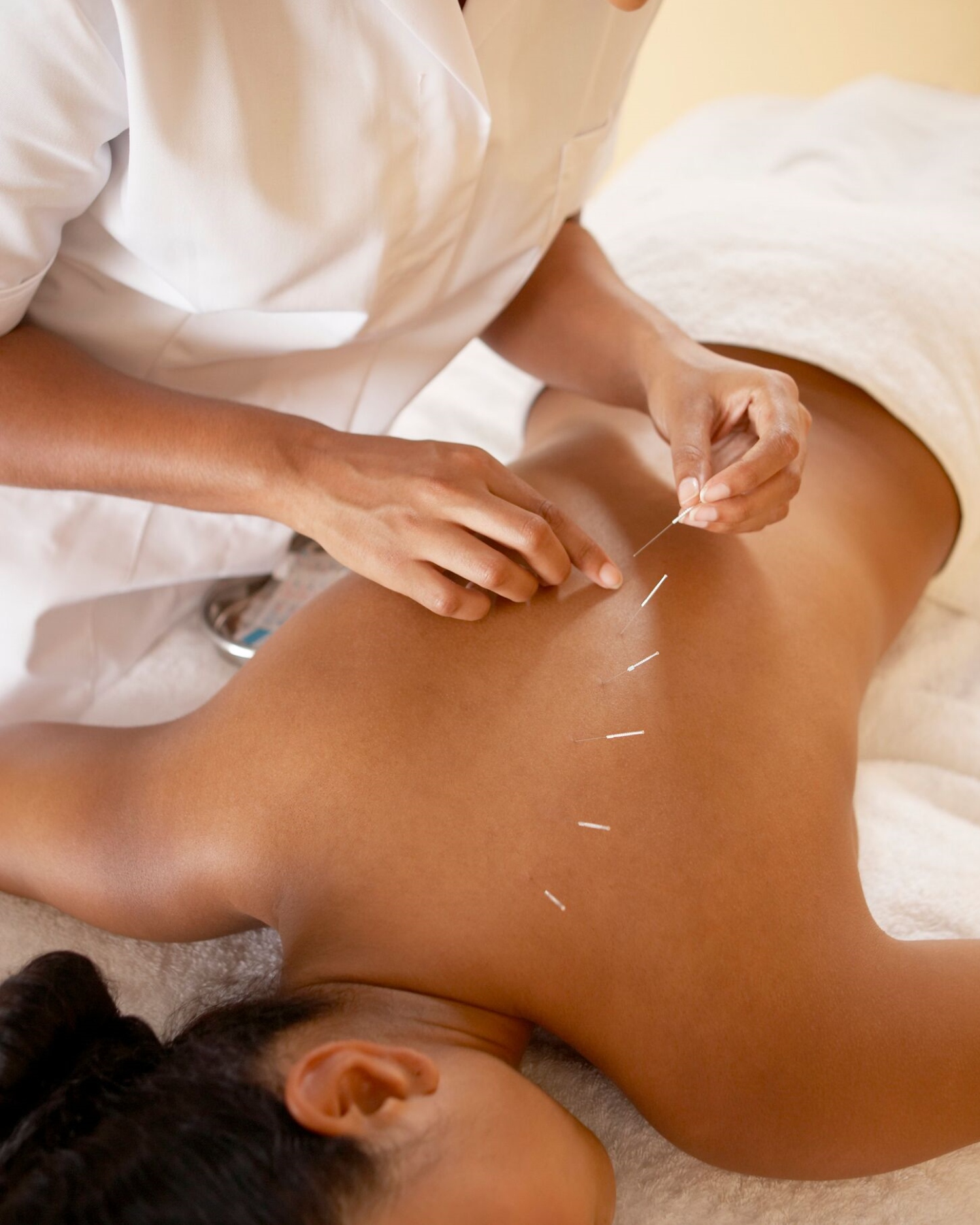 A woman getting acupuncture