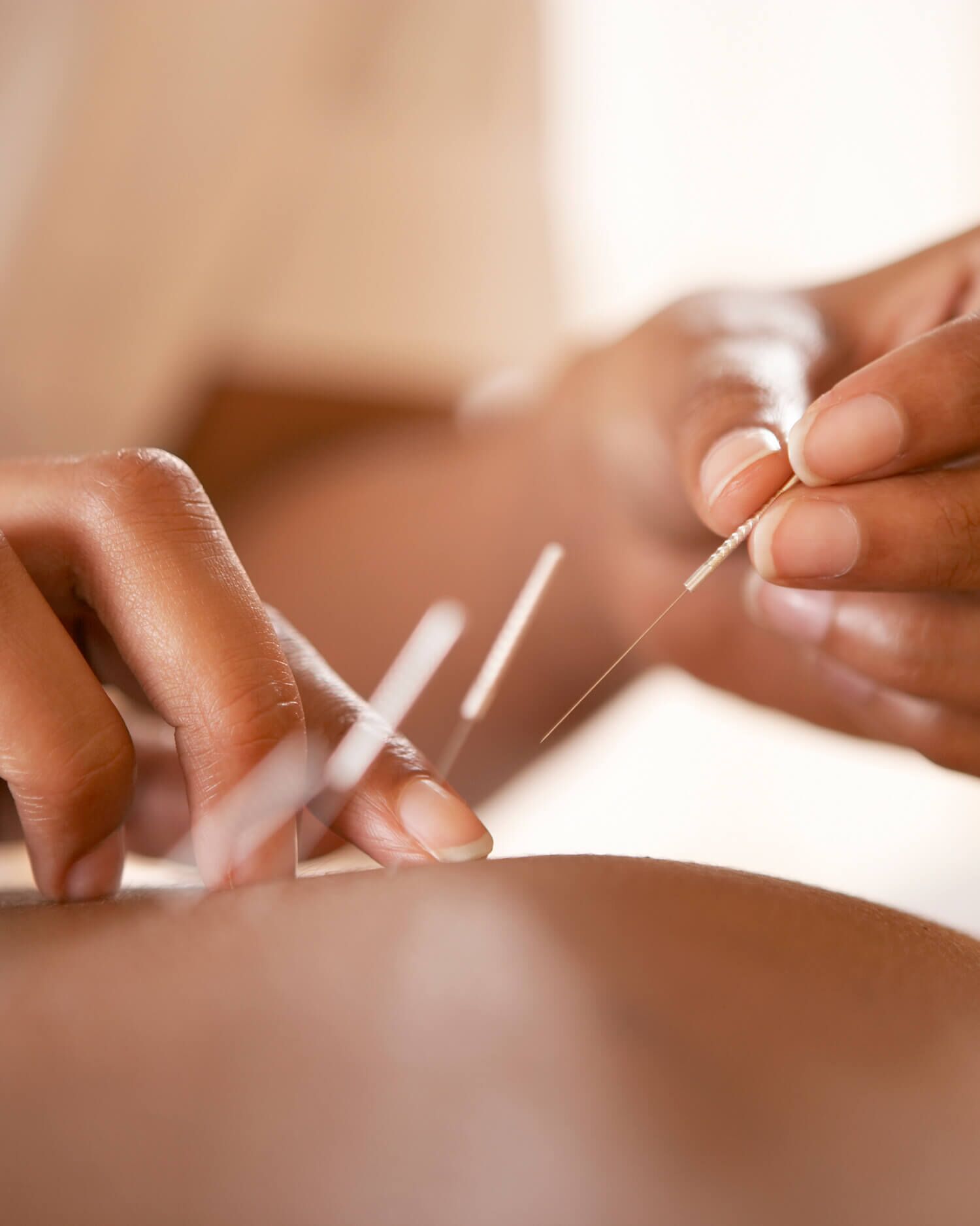 A person getting acupuncture