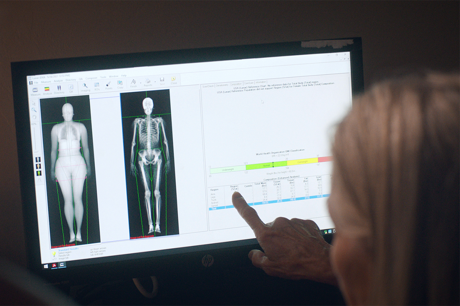 a photo of dexa scan results
