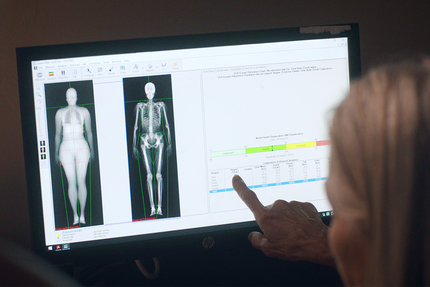 A woman looking at dexa results