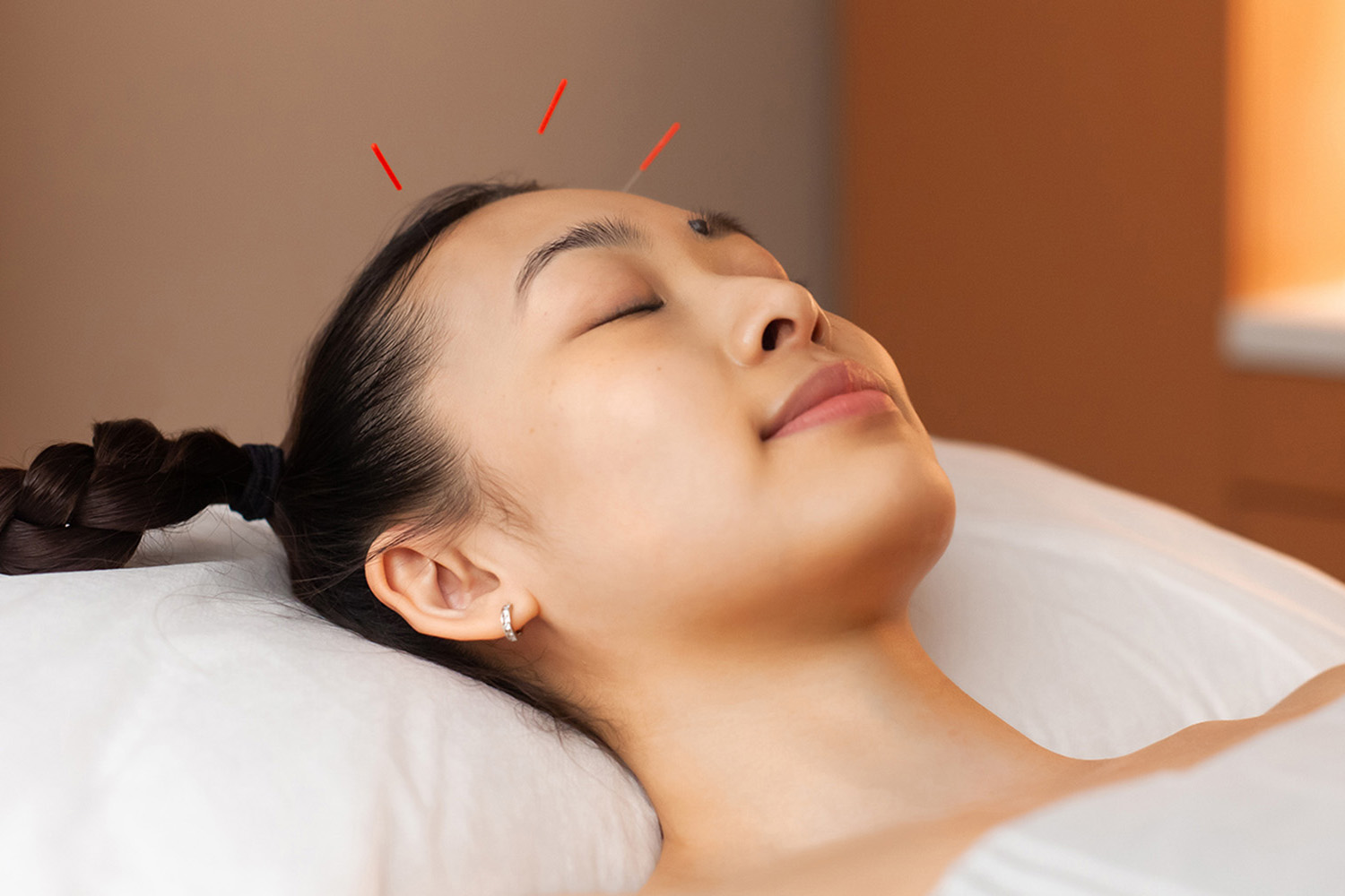 a woman getting acupuncture