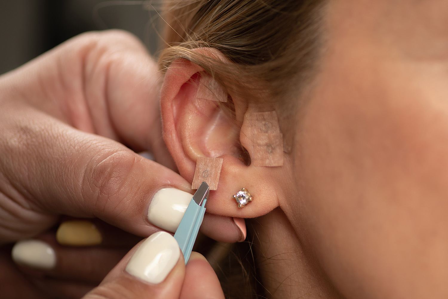 A woman getting acupuncture seeds placed on her ear