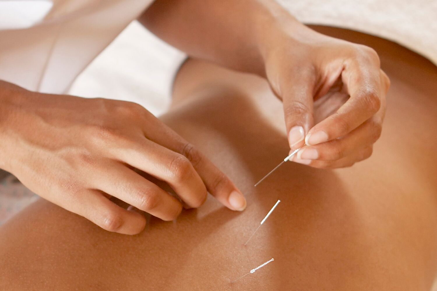 Woman Receiving Acupuncture Service on the Back at Canyon Ranch