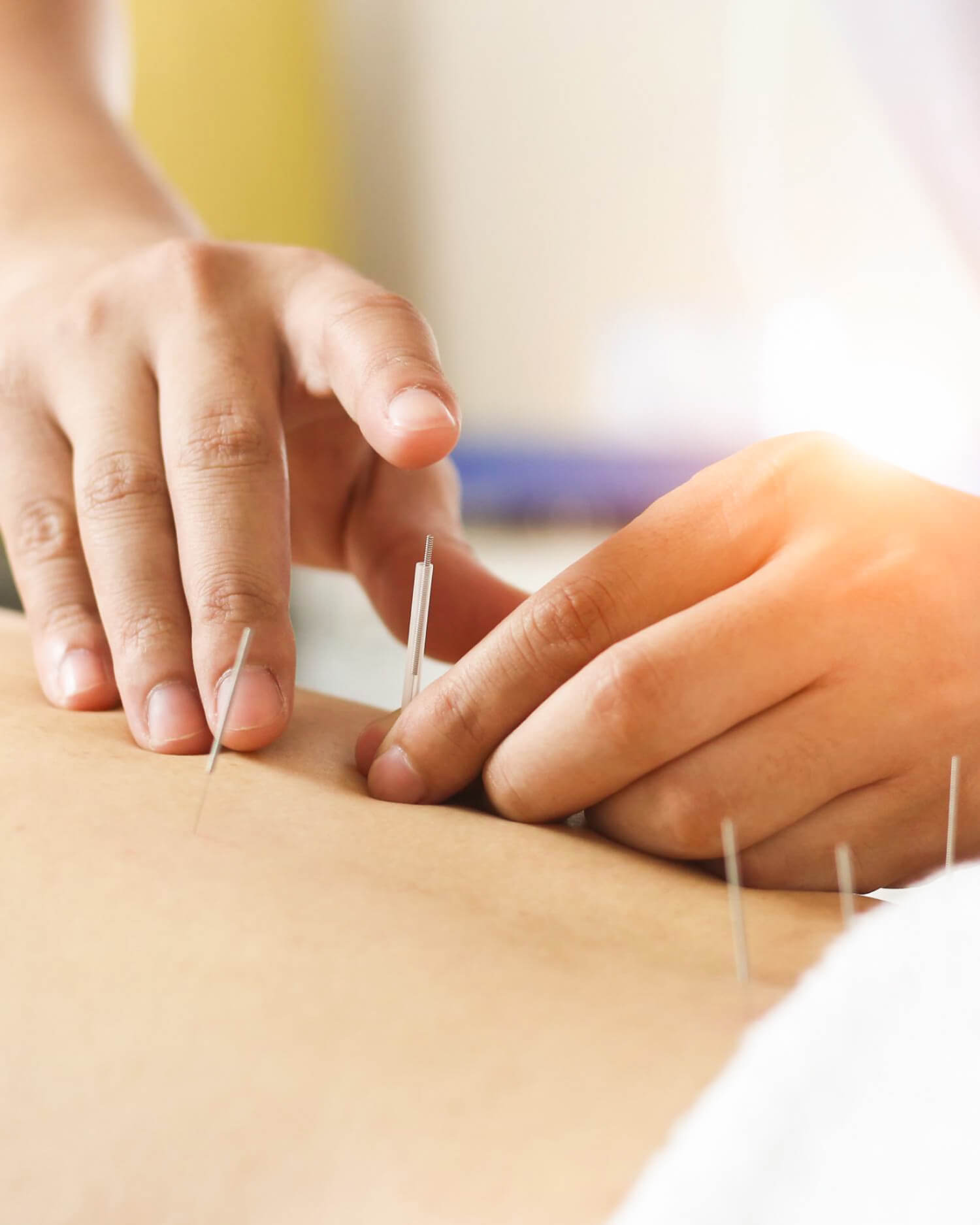 Zoomed in Picture of Acupuncture Needles on Back 