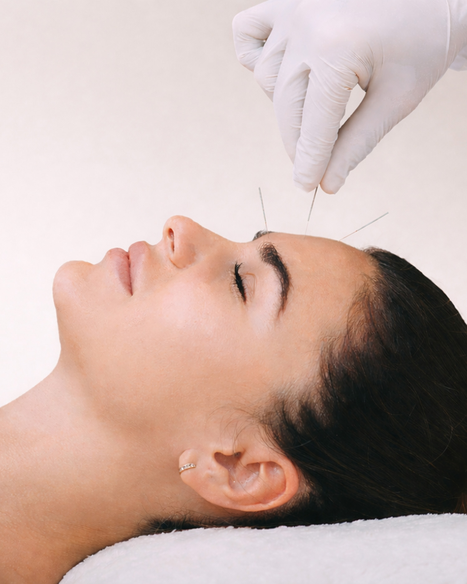 Woman With Acupuncture Needles Placed on Forehead 