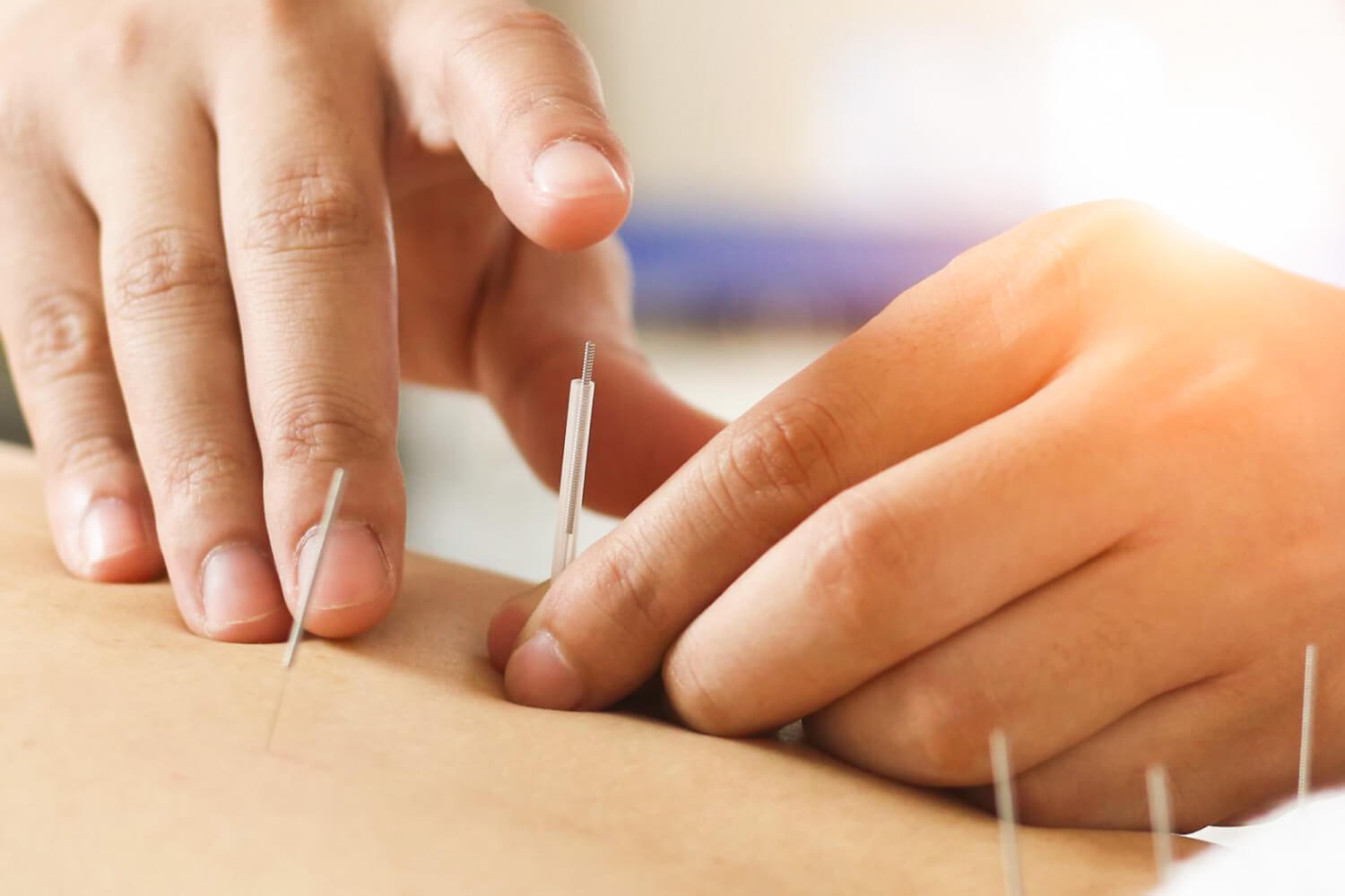 Guest Receiving Acupuncture on Back