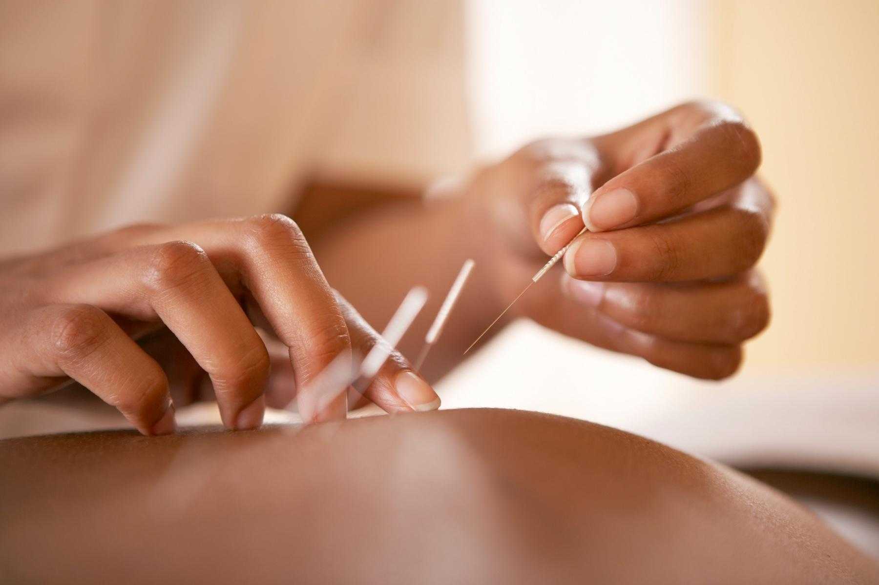 Close-up acupuncture needles in skin.