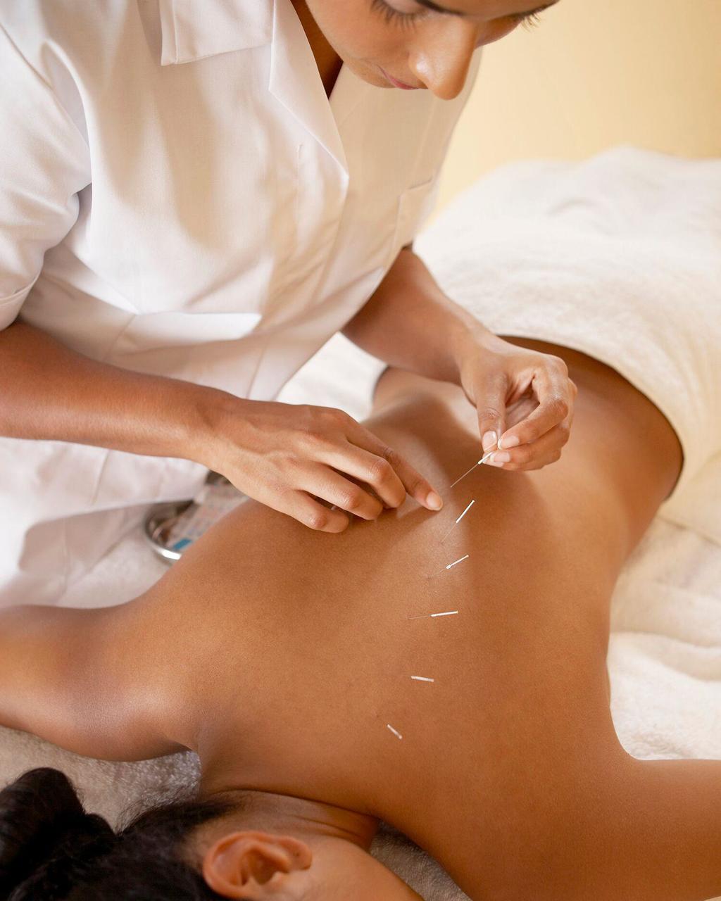 A woman getting acupuncture at Canyon Ranch Spa in Fort Worth.